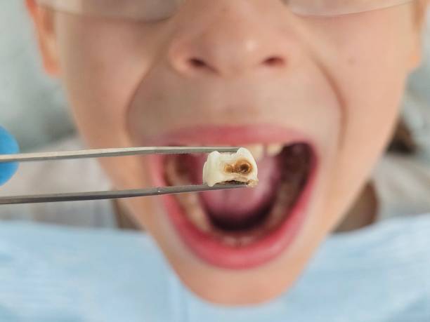 Best Emergency Dentist for Knocked-Out Tooth in South Monrovia Island, CA